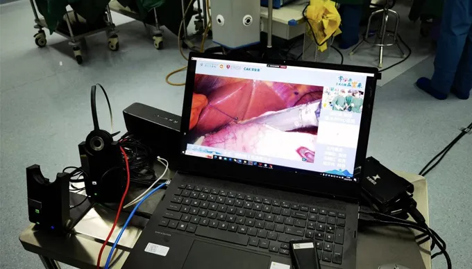 Les agrafeuses chirurgicales CAK brillant dans six chirurgies en direct à travers la Chine